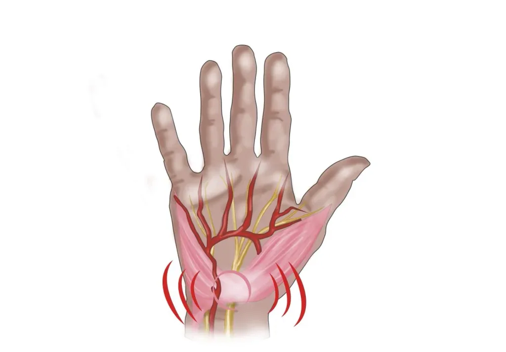 Handgelenkbandage bei Athrose und Karpaltunnel, links, 1 Stück